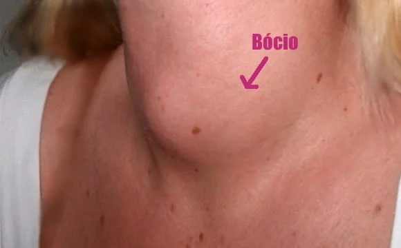 bocio problema tireoide dieta hipotireoidismo hipertireoidismo